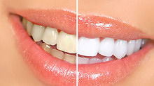 健康生活大调查之牙齿美白方法大比拼