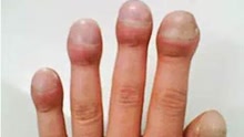 杵状指是先天性心脏病的特征吗？
